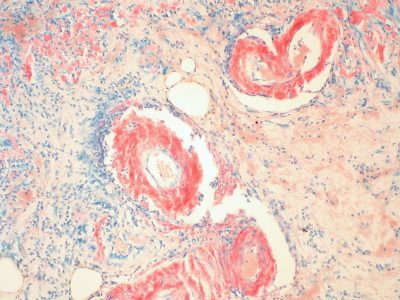 Muestra de tejido con amiloidosis gástrica. Imagen: Ed Uthman (CC BY 2.0, https://creativecommons.org/licenses/by/2.0/).