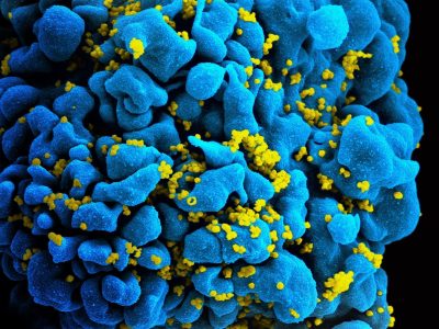 Linfocito infectado por el VIH. Imagen: Instituto Nacional de Alergia y Enfermedades Infecciosas (NIAID). Instituto Nacional de Salud (NIH), EE.UU.