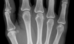 Radiografía de los huesos de la mano de una mujer de 55 años. By Hellerhoff (Own work) [CC-BY-SA-3.0 (http://creativecommons.org/licenses/by-sa/3.0)], via Wikimedia Commons
