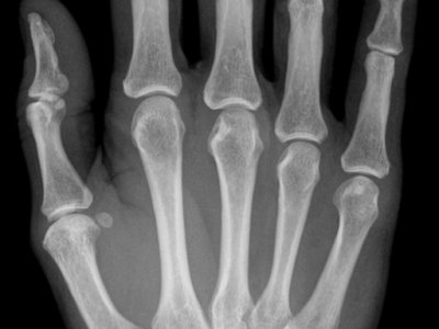 Radiografía de los huesos de la mano de una mujer de 55 años. By Hellerhoff (Own work) [CC-BY-SA-3.0 (http://creativecommons.org/licenses/by-sa/3.0)], via Wikimedia Commons