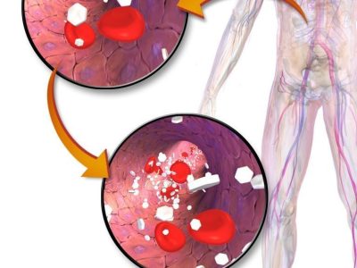 Hiperglucemia y diabetes. Imagen: Blausen.com staff. "Blausen gallery 2014". Wikiversity Journal of Medicine. DOI:10.15347/wjm/2014.010. ISSN 20018762. [CC BY 3.0 (http://creativecommons.org/licenses/by/3.0)].