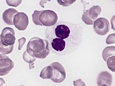 Hypogranular_neutrophil_with_a_pseudo-Pelger-Huet_nucleus_in_MDSb