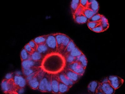 Organoides tumorales derivados de pacientes (Imagen: Enza Lonardo, IRB Barcelona)
