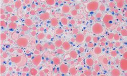 Tinción en secciones de hígado de ratón. Muestran la esteatosis del hígado (hígado graso), con acumulación de grasas, gotas de lípidos en rojo, dentro de las células. En azul, los núcleos celulares. Imagen: C Maíllo, IRB Barcelona.