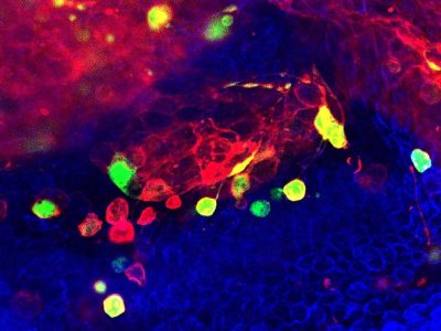 La activación de las caspasas apoptóticas (en verde) en células con altos niveles de inestabilidad cromosómica (en rojo) juega un papel fundamental en la invasividad del tejido. Imagen: Dr. Mariana Muzzopappa, IRB Barcelona.