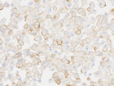 Células tumorales senescentes de melanoma humano. En marrón, la proteína PD-L2 que actúa de escudo protector y evita la acción del sistema inmune (IRB Barcelona). Imagen: IRB Barcelona.