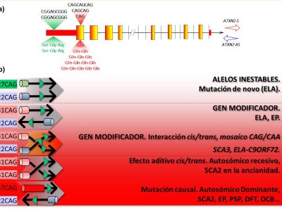 a) Esquema del gen ATXN2 y la posición relativa de las alteraciones genéticas duplicación de 9pb y la expansión de nucleótidos CAG causa monogénica de SCA, y factor de riesgo para ELA, EP y otras enfermedades. También se indica en la parte superior e inferior las secuencias de ADN y los productos de la traducción, Serina (Ser), Glicina (Gly), Arginina (Arg), Glutamina (Gln). En el extremo derecho se indica la dirección de los genes ATXN2-S/AS. b) Mecanismos genéticos del gen ATXN2 (revisado en Pulst et al., 2018 y modificado por Laffita-mesa et al. 2020). 1) Alelos inestables (cilindro verde con líneas intermitentes, flechas en sentido opuesto), largos o mutables ≥27CAG son aquellos que son propensos a expandirse en generaciones sucesivas pudiendo alcanzar el umbral patológico y asociarse o causar alguna enfermedad. 2) Gen modificador, preferentemente alelos de longitud de CAG intermedia y que están en el rango de 27-31CAG asociándose con ELA. Solo un alelo contribuye al fenotipo (flechas en sentido opuesto). 3) Gen modificador con interacción cis-trans (flechas cruzadas) entre la duplicación de 9pb (triangulo verde repetido) en el alelo trans y un alelo cis intermedio. Es el caso en cuestión y en el que se observa un empeoramiento de la SCA3 y la ELA-C9ORF72 al disminuir la edad de debut en al menos 10 años. También pueden existir contribuciones menores como la del mosaico de CAG/CAA. 4) Efecto aditivo de dos alelos intermedios (flechas cruzadas). Los alelos independientes son no penetrantes para SCA2, pero en homocigosis causan SCA2 en la ancianidad apoyando un modelo autosómico recesivo. 5) Mutación causal, el cual es el más común donde un alelo con expansiones ≥33CAG causa SCA2 y es un modelo autosómico dominante (flechas en sentido opuesto). Estos mecanismos se resumen a su vez en tres niveles distintos: no patológico, gen modificador y mutación causal, señalados aquí por línea intermitente y gradiente de color rojo. La duplicación puede a su vez estar presente en el nivel de mutación causal y modificar su expresividad. Las flechas significan los alelos, y su sentido el tipo de interacción.