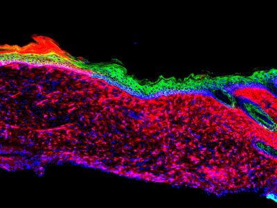 Los investigadores consiguieron regenerar la piel en úlceras reprogramando células mesenquimales de la piel, presentes en abundancia (en rojo) en keratinocitos basales, células progenitoras epiteliales de la piel (en verde).  Imagen: Salk Institute.