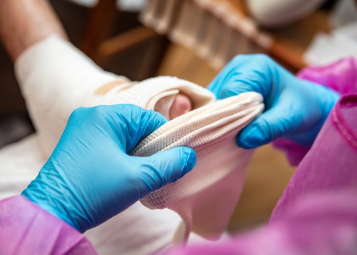 El tratamiento de la epidermólisis ampollosa distrófica recesiva se basaba, hasta hace poco, en los cuidados paliativos. El desarollo de terapia génica como ZEVASKY supone un avance muy importante para los pacientes.