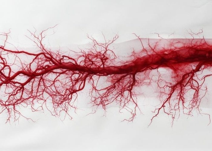 La arteritis de células gigantes afecta principalmente a arterias de gran y mediano calibre, como las que irrigan la cabeza y el cuello