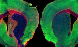 Izquierda, cerebro de ratón después de un ictus, con una extensa pérdida de neuronas y gran respuesta inflamatoria. A la derecha cerebro de un ratón sano. Los niveles de cortistatina se reducen después de un ictus. Imagen: J. Castillo CHUV .
