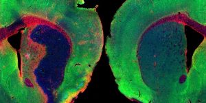 Izquierda, cerebro de ratón después de un ictus, con una extensa pérdida de neuronas y gran respuesta inflamatoria. A la derecha cerebro de un ratón sano. Los niveles de cortistatina se reducen después de un ictus. Imagen: J. Castillo CHUV .