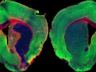 Izquierda, cerebro de ratón después de un ictus, con una extensa pérdida de neuronas y gran respuesta inflamatoria. A la derecha cerebro de un ratón sano. Los niveles de cortistatina se reducen después de un ictus. Imagen: J. Castillo CHUV .