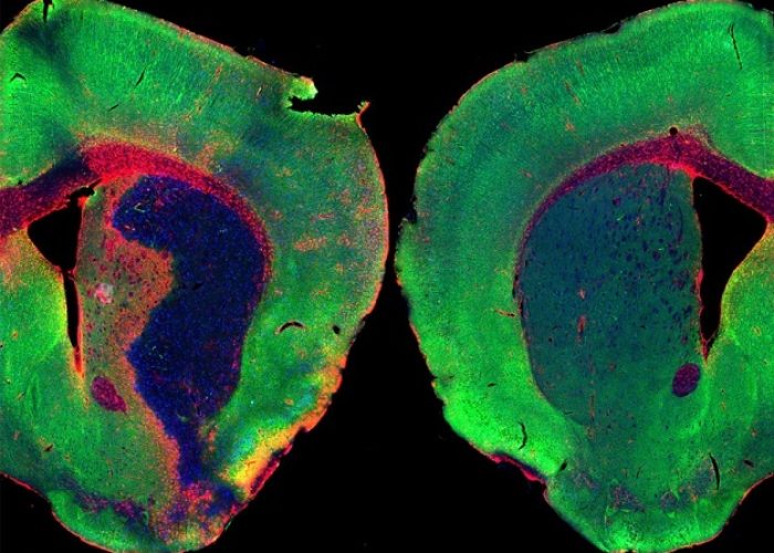 Izquierda, cerebro de ratón después de un ictus, con una extensa pérdida de neuronas y gran respuesta inflamatoria. A la derecha cerebro de un ratón sano. Los niveles de cortistatina se reducen después de un ictus. Imagen: J. Castillo CHUV .