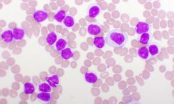 La genética tiene un papel relevante en oncohematología, en el diagnóstico, monitorización y tratamiento de numerosas neoplasias hematológicas.