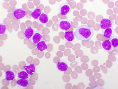 La genética tiene un papel relevante en oncohematología, en el diagnóstico, monitorización y tratamiento de numerosas neoplasias hematológicas.