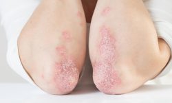 La psoriasis es una enfermedad cutánea crónica, con un considerable  componente genético. Imagen: Adobe Express.
