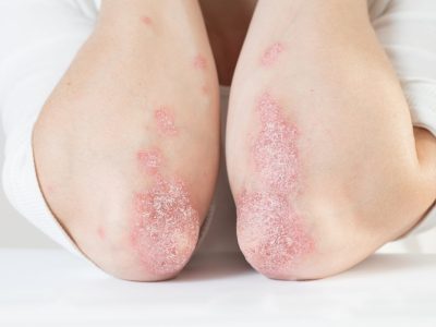 La psoriasis es una enfermedad cutánea crónica, con un considerable  componente genético. Imagen: Adobe Express.