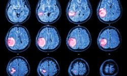 La secuenciación mediante nanoporos podría permitir clasificar tumores del sistema nervioso central de forma rápida