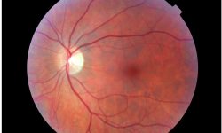 Las distrofias hereditarias de la retina son enfermedades en las que están involucradas diferentes genes