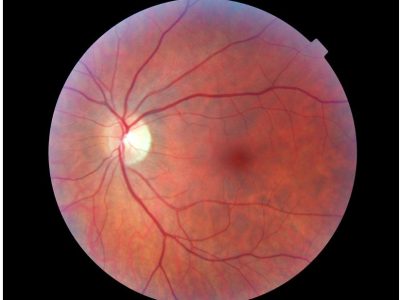 Las distrofias hereditarias de la retina son enfermedades en las que están involucradas diferentes genes