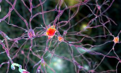Las neuronas más afectadas en la enfermedad de Huntington se localizan en la región cerebral del estriado, donde se administra la terapia génica experimental. Imagen: Adobe Express.