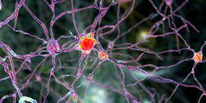 Las neuronas más afectadas en la enfermedad de Huntington se localizan en la región cerebral del estriado, donde se administra la terapia génica experimental. Imagen: Adobe Express.