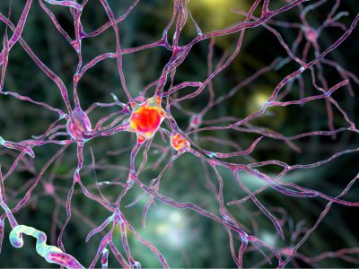 Las neuronas más afectadas en la enfermedad de Huntington se localizan en la región cerebral del estriado, donde se administra la terapia génica experimental. Imagen: Adobe Express.