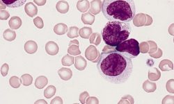 leucemia mieloide aguda inmunoterapia