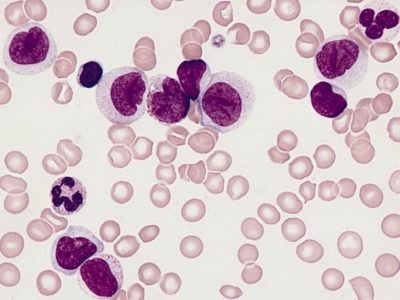 Células de leucemia mieloide aguda. Imagen: The Armed Forces Institute of Pathology (AFIP).