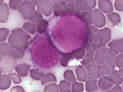 Células de leucemia. Imagen: A Surprising New Path to Tumor Development. PLoS Biol 3(12): e433. doi:10.1371/journal.pbio.0030433 CC-BY-2.5