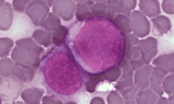 Células de leucemia. Imagen: A Surprising New Path to Tumor Development. PLoS Biol 3(12): e433. doi:10.1371/journal.pbio.0030433 CC-BY-2.5