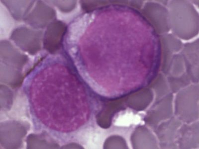 Leukemia_cells2