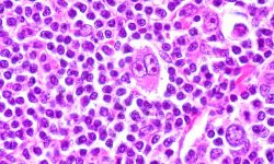 Células de Reed-Sternberg observadas al microscopio, características del linfoma de Hodgkin. Su presencia permite diferenciar esta enfermedad de otros tipos de linfoma. Imagen: Ed Uthman (CC BY 2.0).