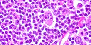 Células de Reed-Sternberg observadas al microscopio, características del linfoma de Hodgkin. Su presencia permite diferenciar esta enfermedad de otros tipos de linfoma. Imagen: Ed Uthman (CC BY 2.0).