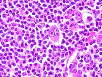 Células de Reed-Sternberg observadas al microscopio, características del linfoma de Hodgkin. Su presencia permite diferenciar esta enfermedad de otros tipos de linfoma. Imagen: Ed Uthman (CC BY 2.0).