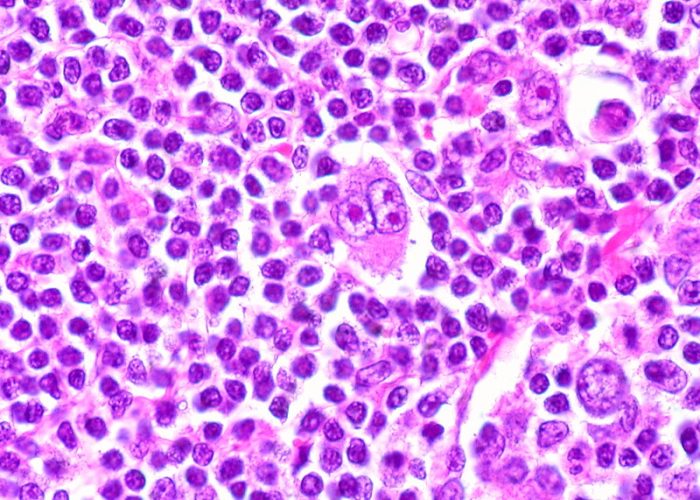 Células de Reed-Sternberg observadas al microscopio, características del linfoma de Hodgkin. Su presencia permite diferenciar esta enfermedad de otros tipos de linfoma. Imagen: Ed Uthman (CC BY 2.0).