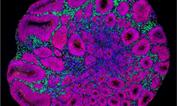 Imagen al microscopio de un organoide cerebral que muestra precursores neuronales (en magenta) y neuronas de proyección a capas más profundas de neuronas (en verde) que son los tipos de células afectadas por las mutaciones de riesgo para el autismo. Imagen: Paola Arlotta laboratory at Harvard University and Kwanghun Chung laboratory at MIT.