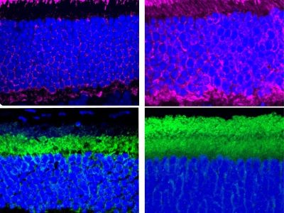 En el tejido del ojo de un modelo de ratón con síndrome de Usher (derecha) las proteínas del ciclo luz-oscuridad (en morado y verde) se encuentran distribuidas en los dos compartimentos de fotorreceptores en lugar de en uno u otro, como ocurre en el tejido de ratones sanos (izquierda). Imagen: eLife.
