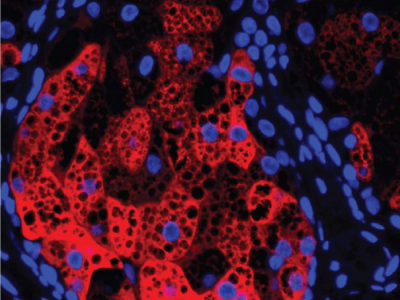 Tinción de BSD3B1 (en rojo9 dentro de una glándula sebácea humana. Los núcleos de las células se muestran en azul y las pequeñas gotas de lípidos como áreas circulares negras en el interior de las células. Imagen: UT Southwestern Medical Center.