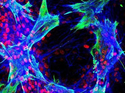 Imagen de inmunofluorescencia que muestra células estrelladas hepáticas primarias humanas que interactúan con células progenitoras hepáticas bipotentes in vitro. Los cultivos se marcaron utilizando anticuerpos contra vimentina (verde), HNF4a (rojo) y se trataron con faloidina (azul). El estudio mostró que la diferenciación de las células progenitoras se localizó en los sitios de contacto entre los dos tipos de células. Imagen: CIBERDEM.
