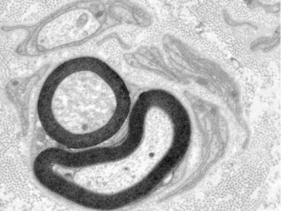 Figura 2. Biopsia de nervio sural donde se observa la pérdida de fibras dentro de un axón mielinizado (flecha). Barra de escala = 2 micras. Imagen, cortesía de los autores.