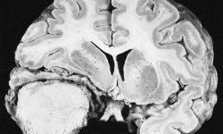 Los meningiomas son tumores que se desarrollan de las membranas que cubren al cerebro y a la médula espinal. El estudio indica que las mutaciones somáticas en el gen POLR2A son recurrentes en los menigiomas. Imagen: The Armed Forces Institute of Pathology (AFIP) - PEIR Digital Library.
