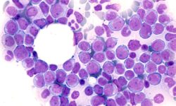 En algunos pacientes la leucemia mielomonocítica crónica puede evolucionar a leucemia mieloide aguda.
