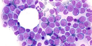 En algunos pacientes la leucemia mielomonocítica crónica puede evolucionar a leucemia mieloide aguda.