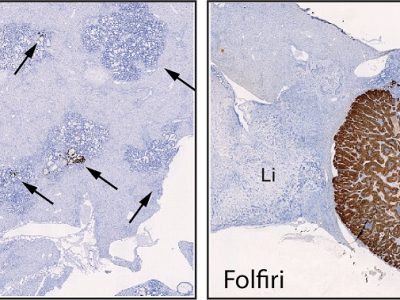 Las células no proliferativas (en marrón) no contribuyen al crecimiento del tumor en un principio (imagen de la izquierda) pero son resistentes a la quimioterapia. Estas células, que expresan un gen llamado Mex3a, son capaces de regenerar los tumores una vez el tratamiento ha finalizado (imagen de la derecha). Imagen: IRB Barcelona.