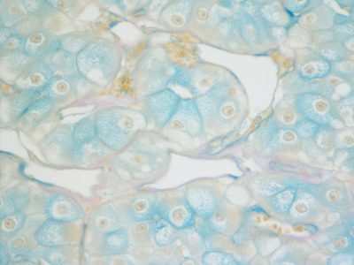 Carcinoma de células renales. Imagen:cnicholsonpath (CC BY 2.0, https://creativecommons.org/licenses/by/2.0/).