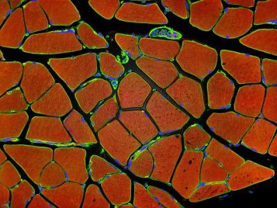 La distrofia miotónica congénita  muestra una herencia con sesgo materno, cuyas causas suponen un misterio para los investigadores. Imagen. Sección de músculo esquelético humano, Tom Deerinck, National Center for Microscopy and Imaging Research (NCMIR).