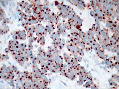 Carcinoma pulmonar de células pequeñas. Imagen: By Ed Uthman from Houston, TX, USA [CC-BY-2.0 (http://creativecommons.org/licenses/by/2.0)], via Wikimedia Commons