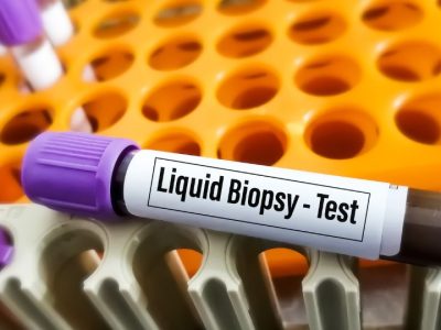 Test para hacer una biopsia líquida en cancer